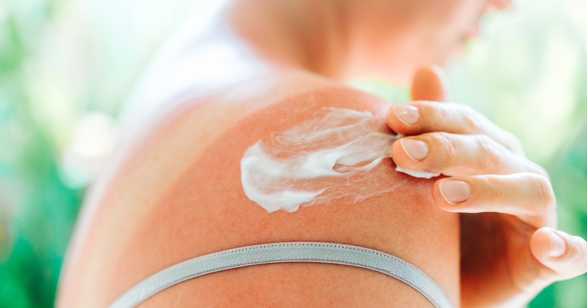 Heat rash or sun poisoning? Derms say the difference is in the symptoms